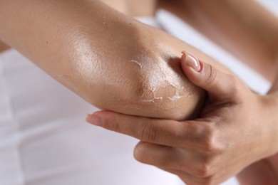 Photo of Woman with dry skin on her elbow, closeup