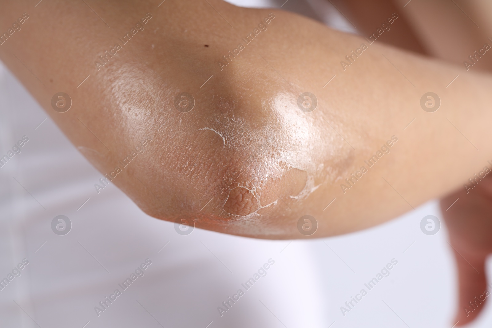 Photo of Woman with dry skin on her elbow against light background, closeup