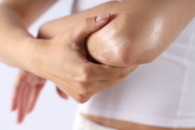 Photo of Woman with dry skin on her elbow against light background, closeup