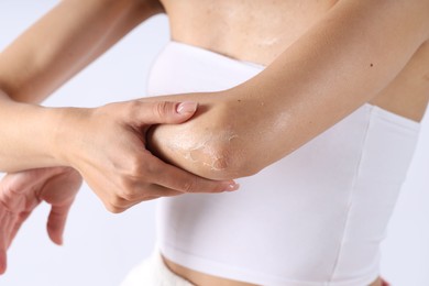 Photo of Woman with dry skin on her elbow against light background, closeup