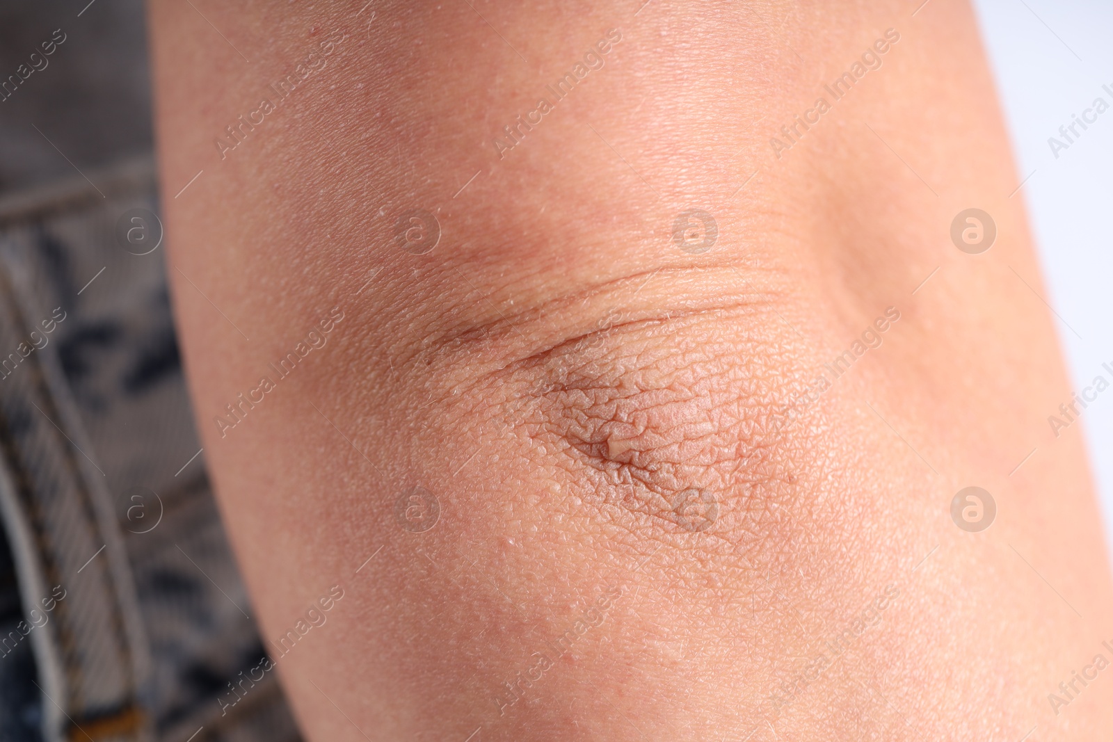 Photo of Woman with dry skin on her elbow against blurred background, closeup