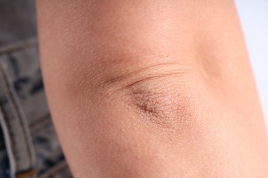 Photo of Woman with dry skin on her elbow against blurred background, closeup
