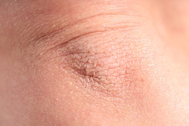 Photo of Texture of dry skin as background, closeup
