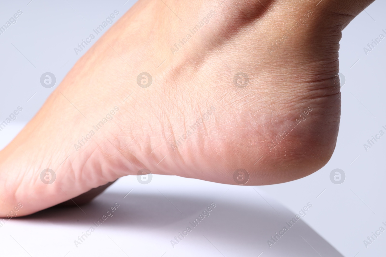 Photo of Woman with dry skin on her foot against light background, closeup