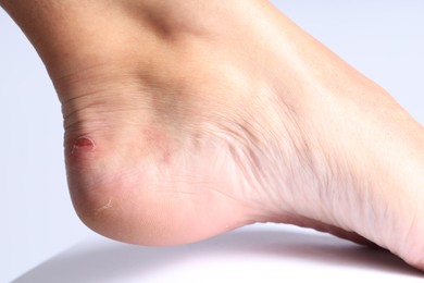 Photo of Woman with dry skin on her foot against light background, closeup