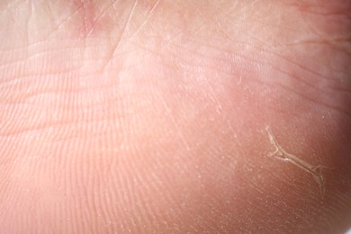 Photo of Woman with dry skin on her foot, closeup