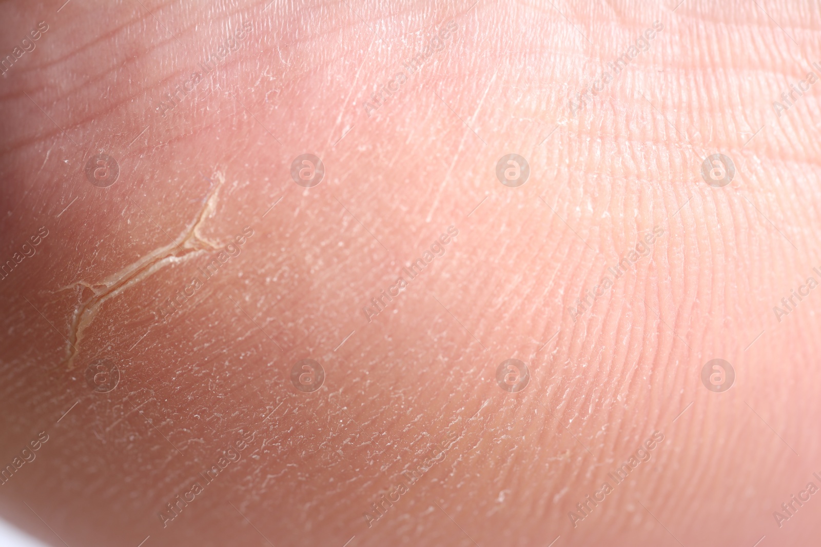 Photo of Woman with dry skin on her foot, closeup