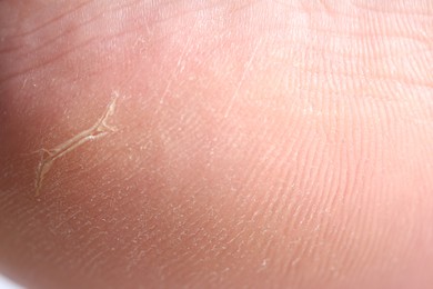 Photo of Woman with dry skin on her foot, closeup