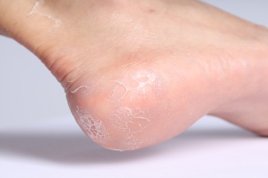Photo of Woman with dry skin on her foot against light background, closeup