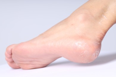 Photo of Woman with dry skin on her foot against light background, closeup