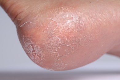 Photo of Woman with dry skin on her foot against light background, closeup