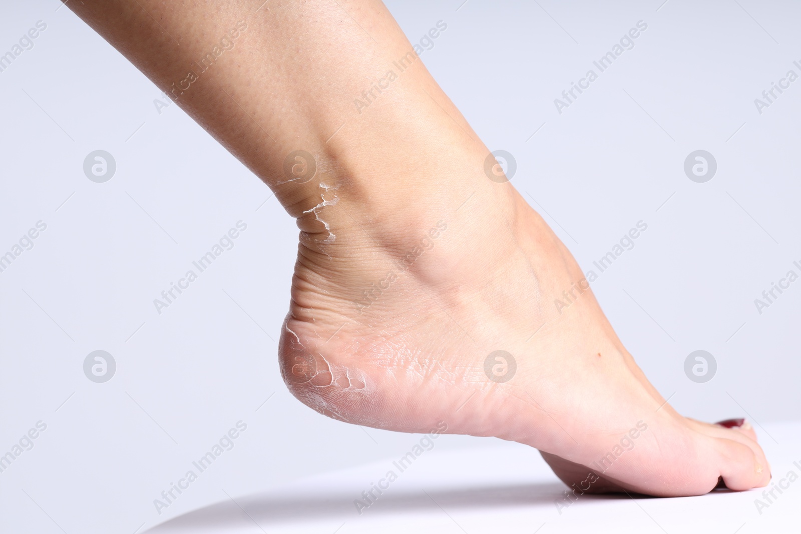 Photo of Woman with dry skin on her foot against light background, closeup