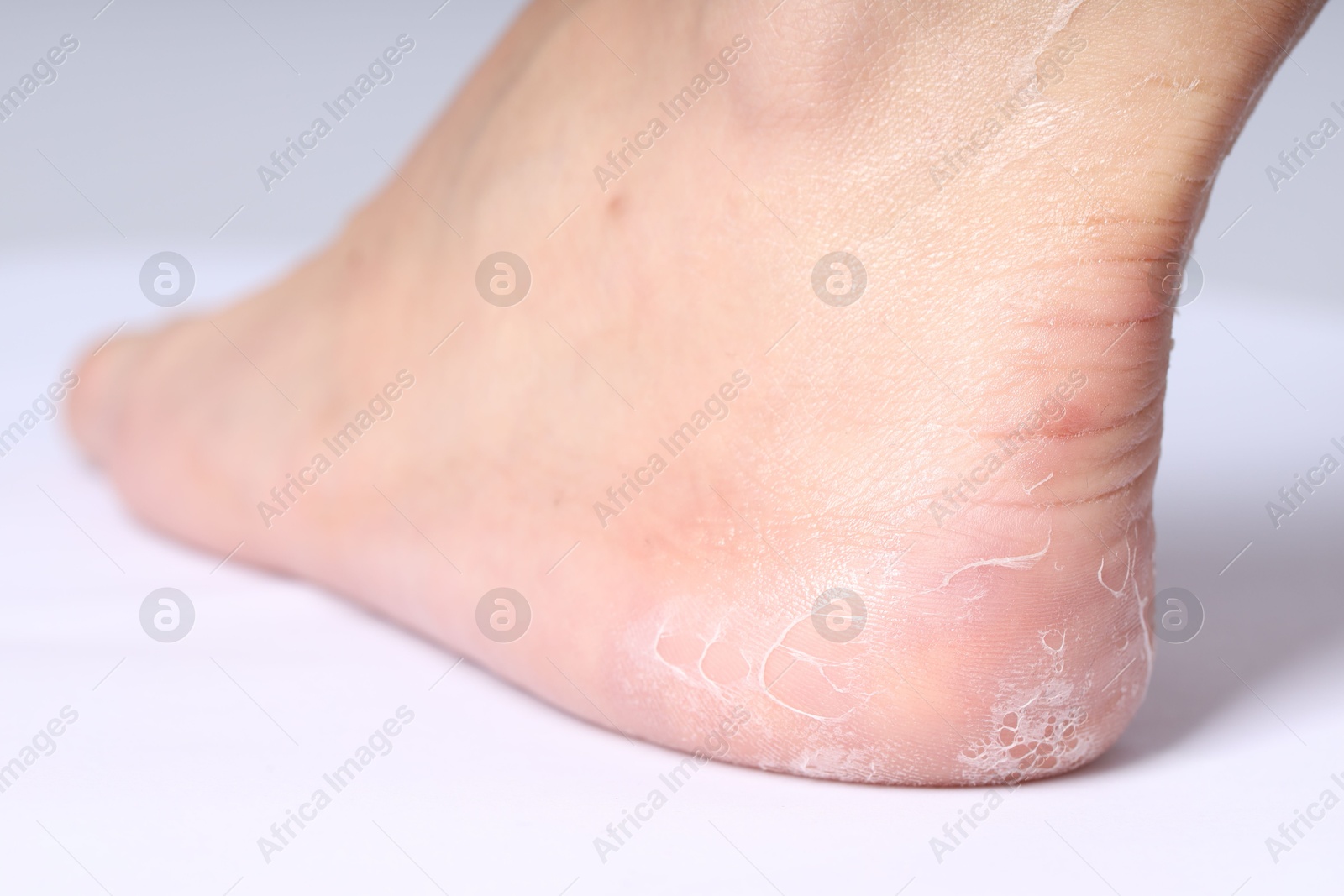 Photo of Woman with dry skin on her foot against light background, closeup