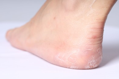 Photo of Woman with dry skin on her foot against light background, closeup