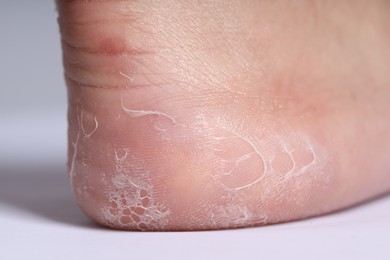 Photo of Woman with dry skin on her foot against light background, closeup
