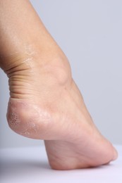 Photo of Woman with dry skin on her foot against light background, closeup