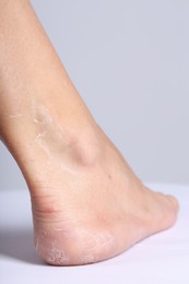 Photo of Woman with dry skin on her foot against light background, closeup