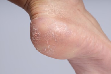 Photo of Woman with dry skin on her foot against light background, closeup