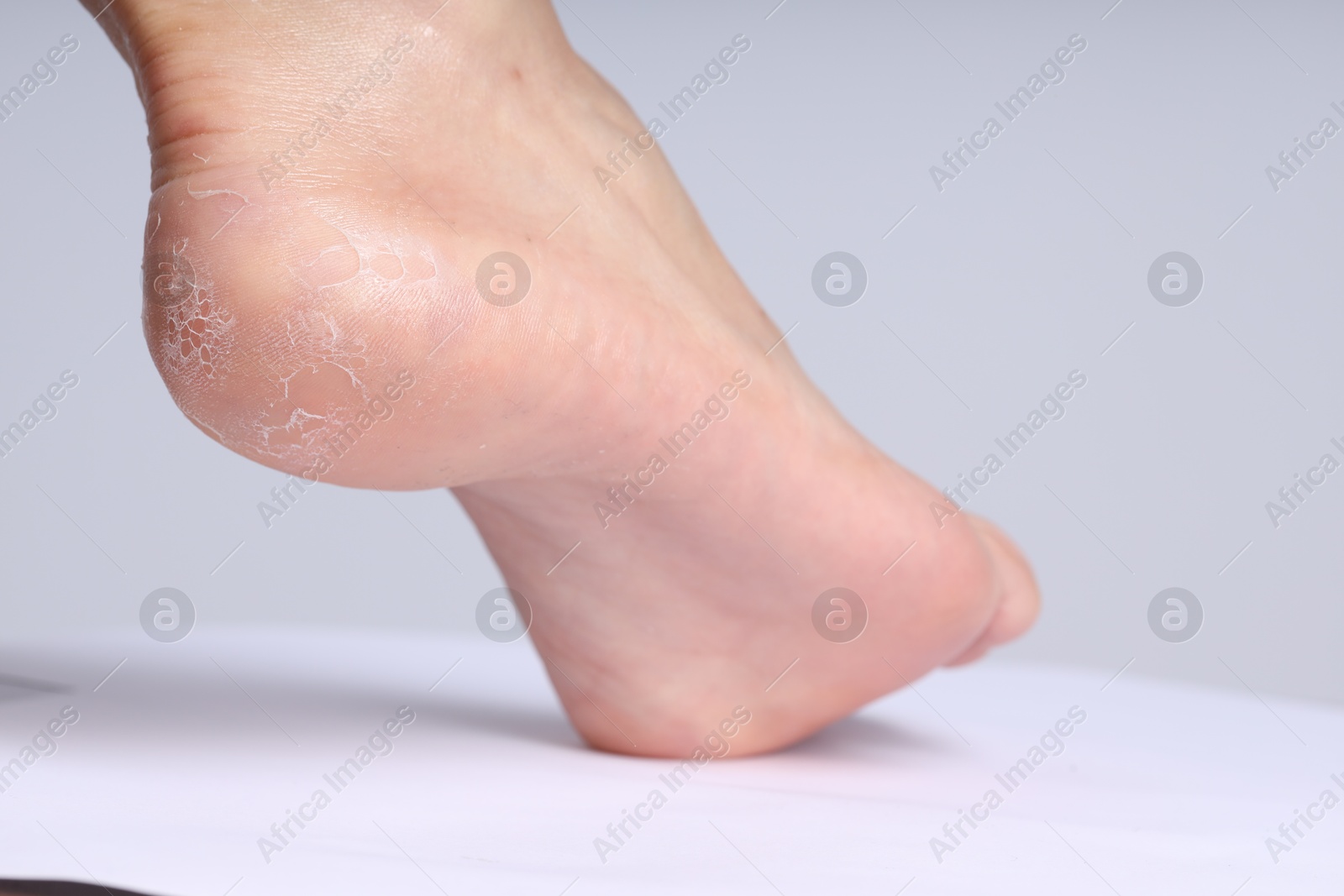 Photo of Woman with dry skin on her foot against light background, closeup