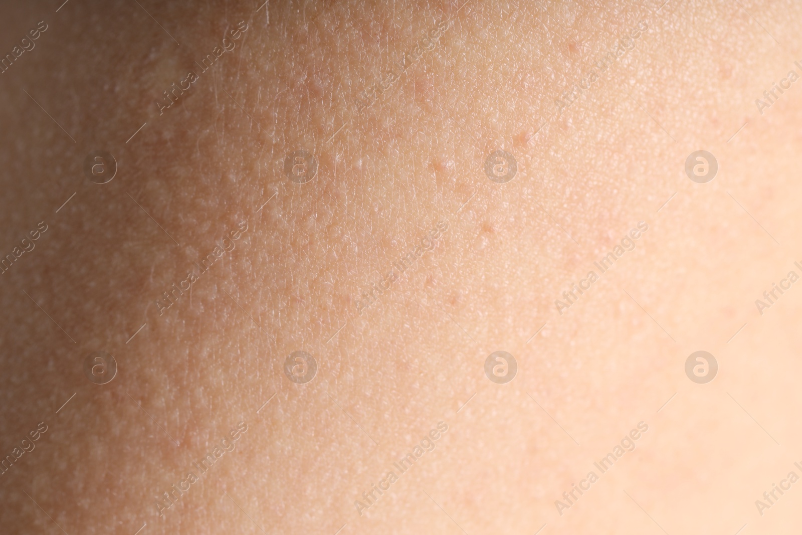Photo of Texture of normal skin as background, closeup