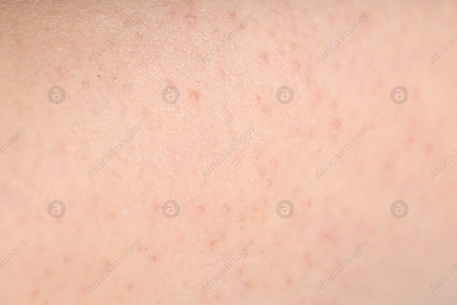 Photo of Texture of normal skin as background, closeup