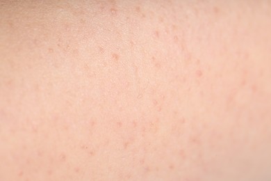 Photo of Texture of normal skin as background, closeup