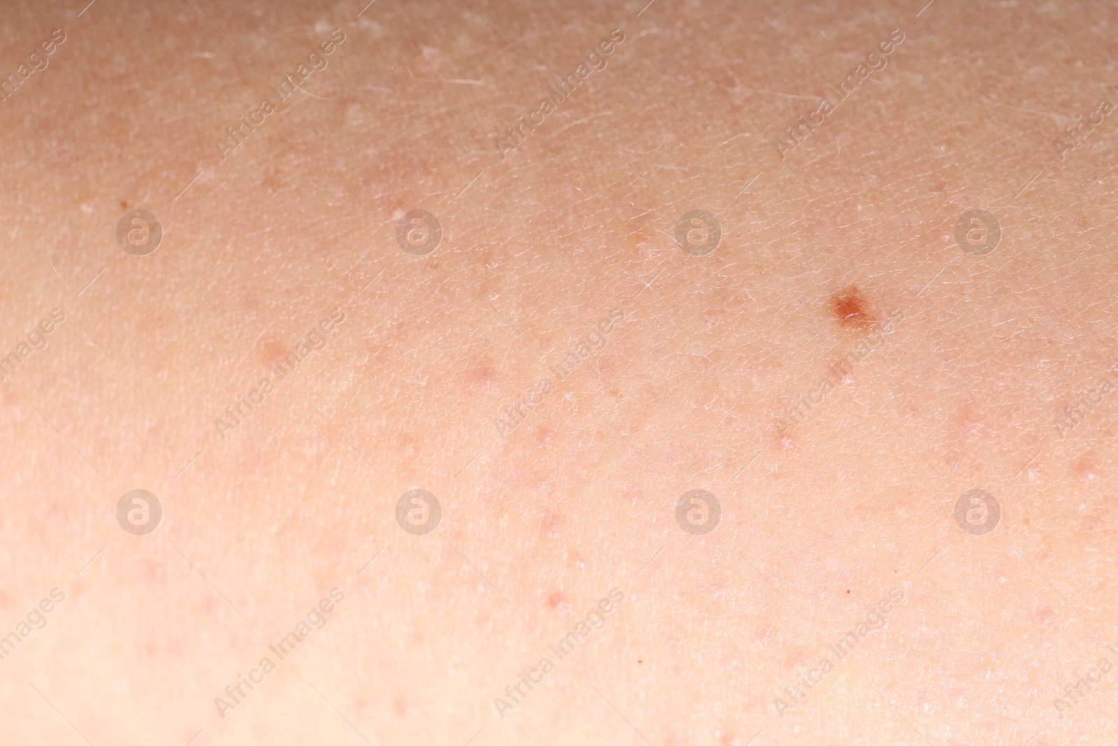 Photo of Texture of normal skin as background, closeup