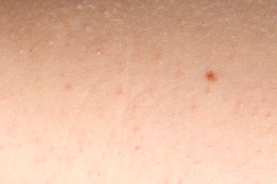 Photo of Texture of normal skin as background, closeup