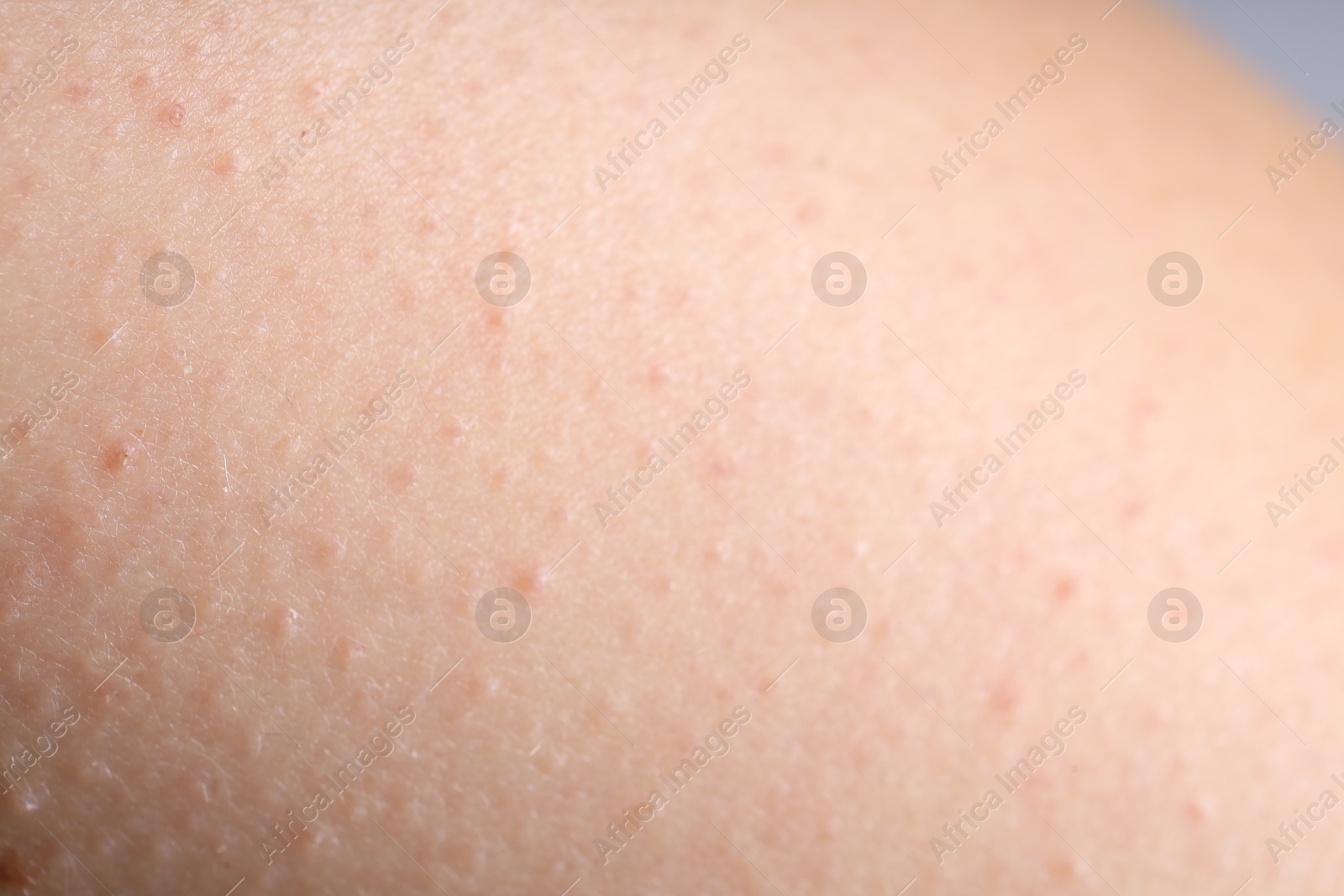 Photo of Texture of normal skin as background, closeup