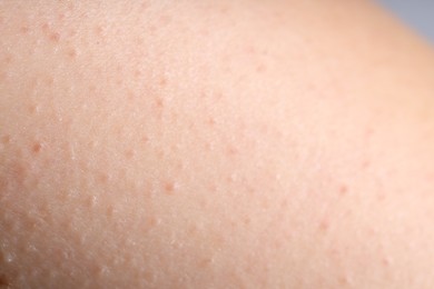 Photo of Texture of normal skin as background, closeup