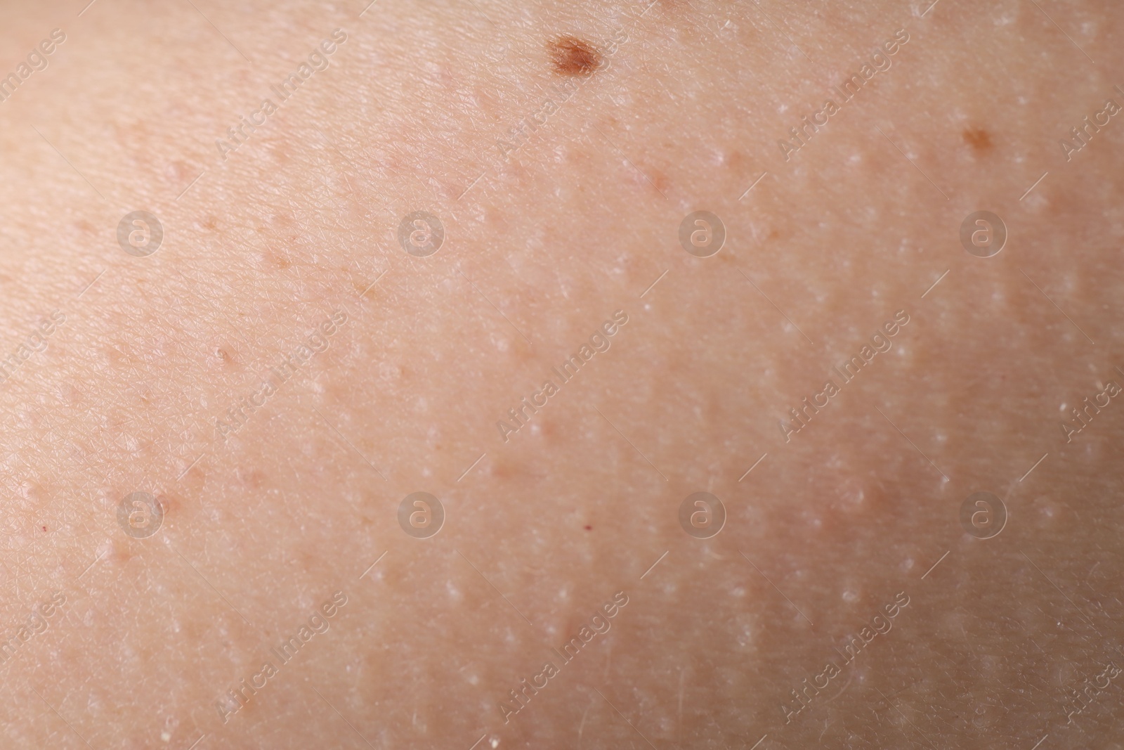 Photo of Texture of normal skin as background, closeup
