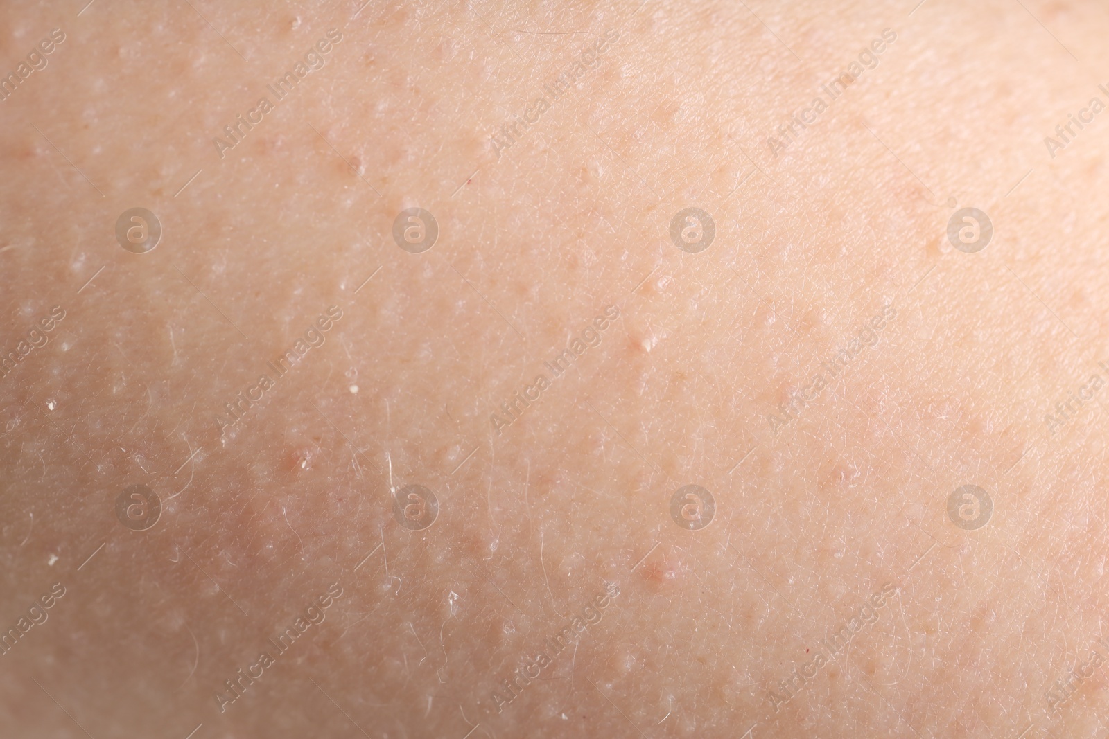 Photo of Texture of normal skin as background, closeup