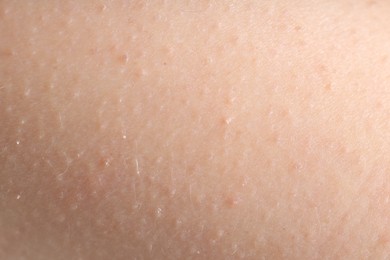 Photo of Texture of normal skin as background, closeup