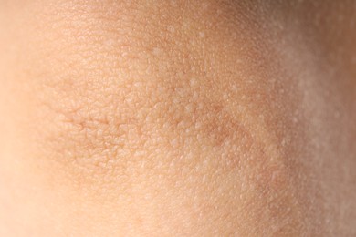 Photo of Texture of normal skin as background, closeup