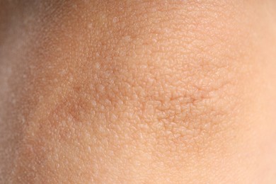 Photo of Texture of normal skin as background, closeup
