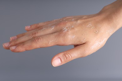 Photo of Woman with dry skin on her hand against grey background, closeup