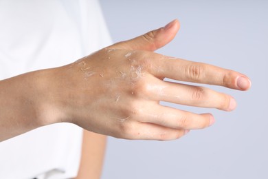Photo of Woman with dry skin on her hand against light background, closeup