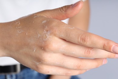 Photo of Woman with dry skin on her hand against light background, closeup