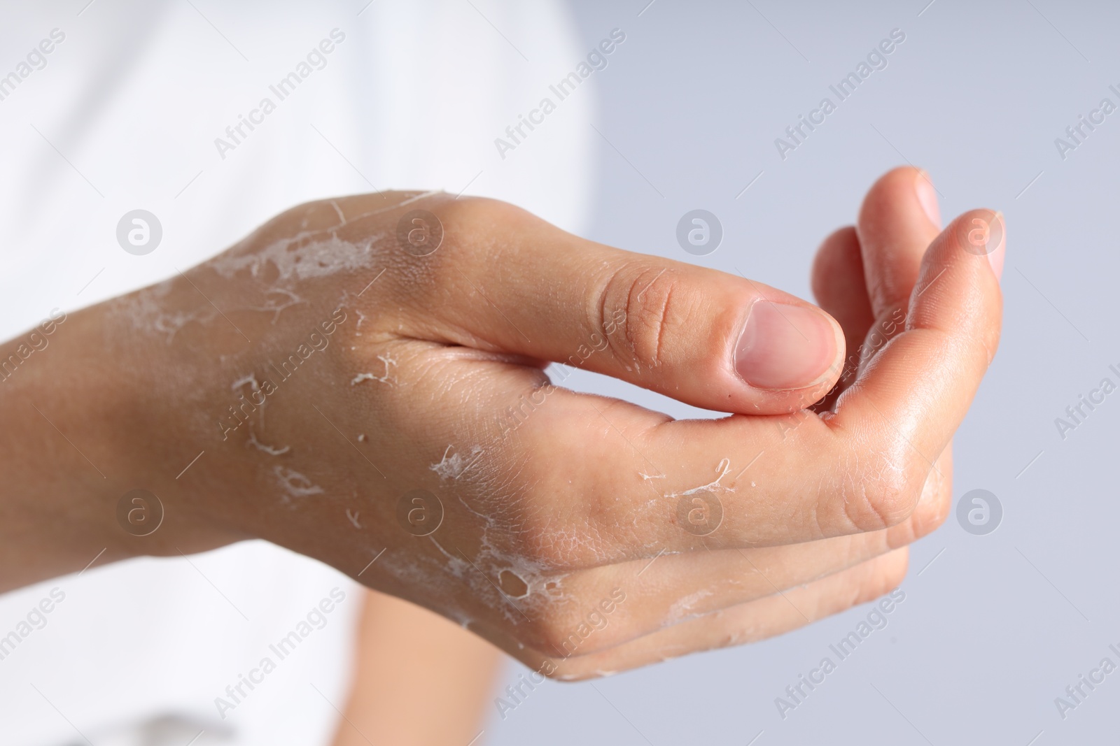 Photo of Woman with dry skin on her hand against light background, closeup