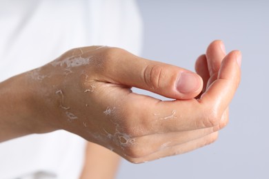 Photo of Woman with dry skin on her hand against light background, closeup