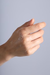 Photo of Woman with dry skin on her hand against light background, closeup