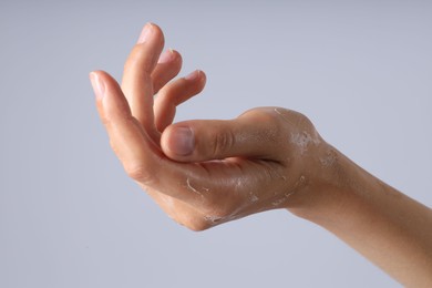 Photo of Woman with dry skin on her hand against light background, closeup