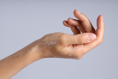 Photo of Woman with dry skin on her hand against light background, closeup