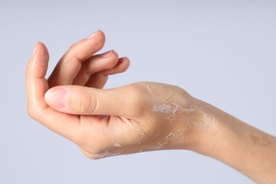 Photo of Woman with dry skin on her hand against light background, closeup