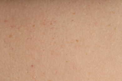 Photo of Texture of normal skin as background, closeup