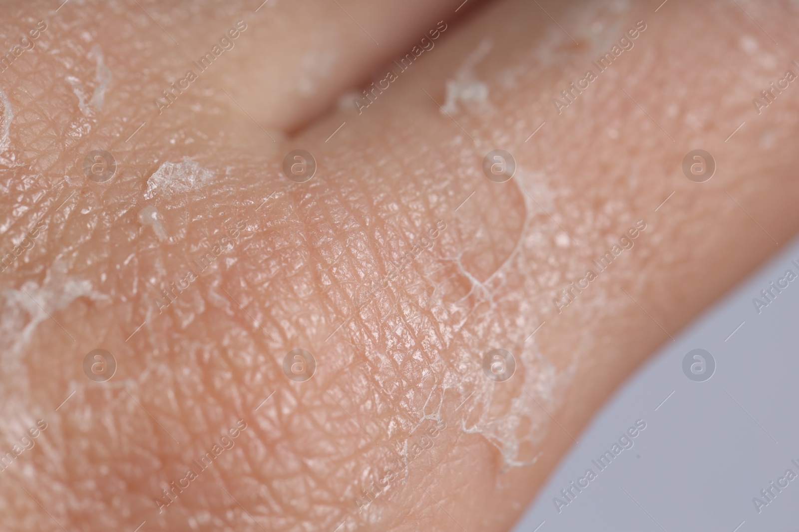 Photo of Woman with dry skin on her hand against light background, closeup