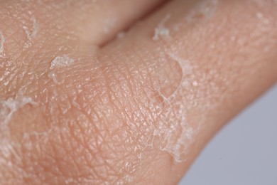 Photo of Woman with dry skin on her hand against light background, closeup