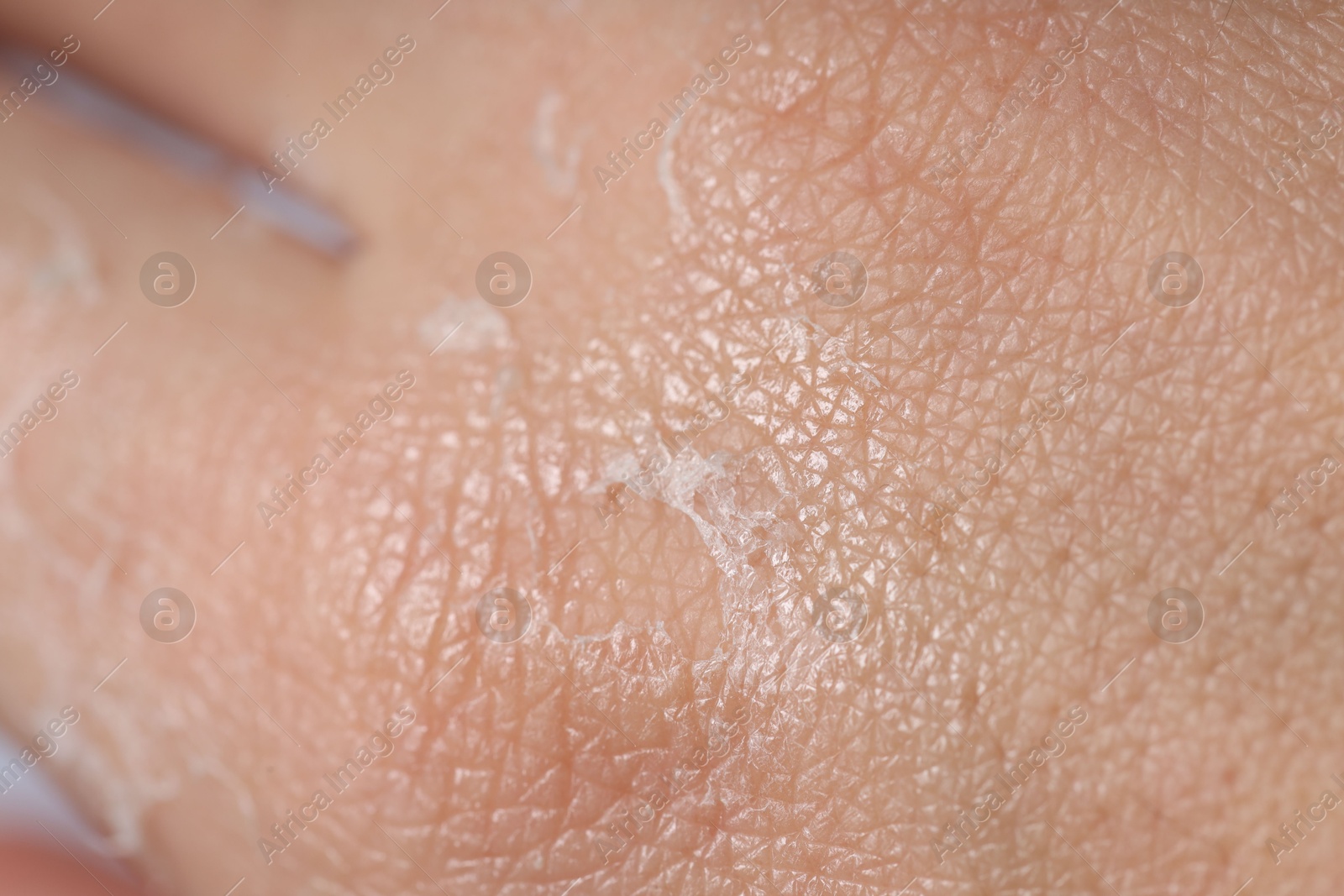 Photo of Woman with dry skin on her hand, closeup