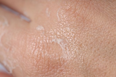 Photo of Woman with dry skin on her hand, closeup
