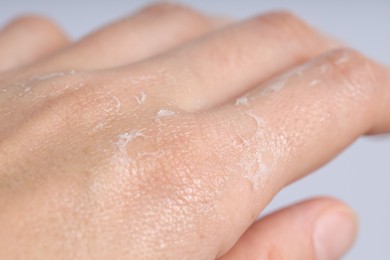 Photo of Woman with dry skin on her hand against light background, closeup